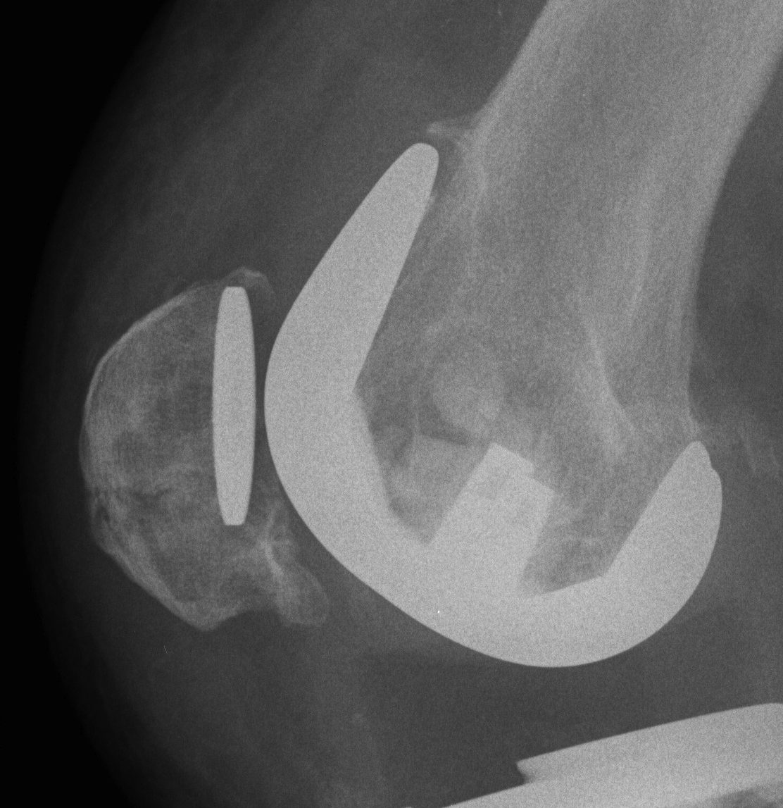 TKR Patella Fracture Undisplaced